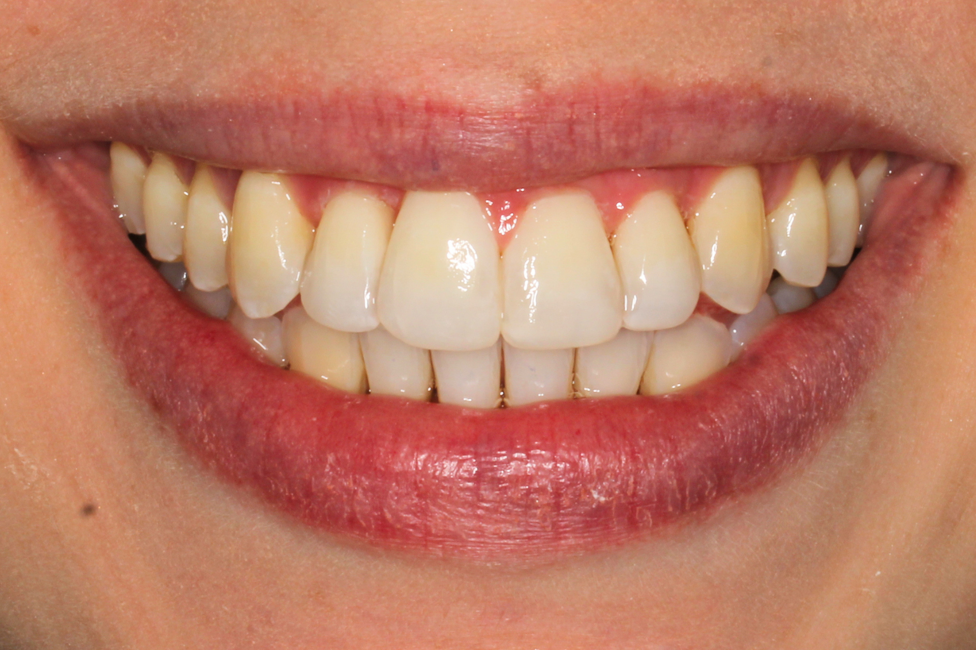 Invis + Composite Bonding After