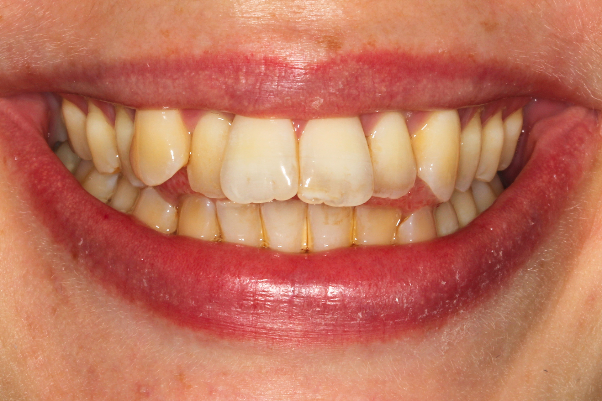 Invis + Composite Bonding Before