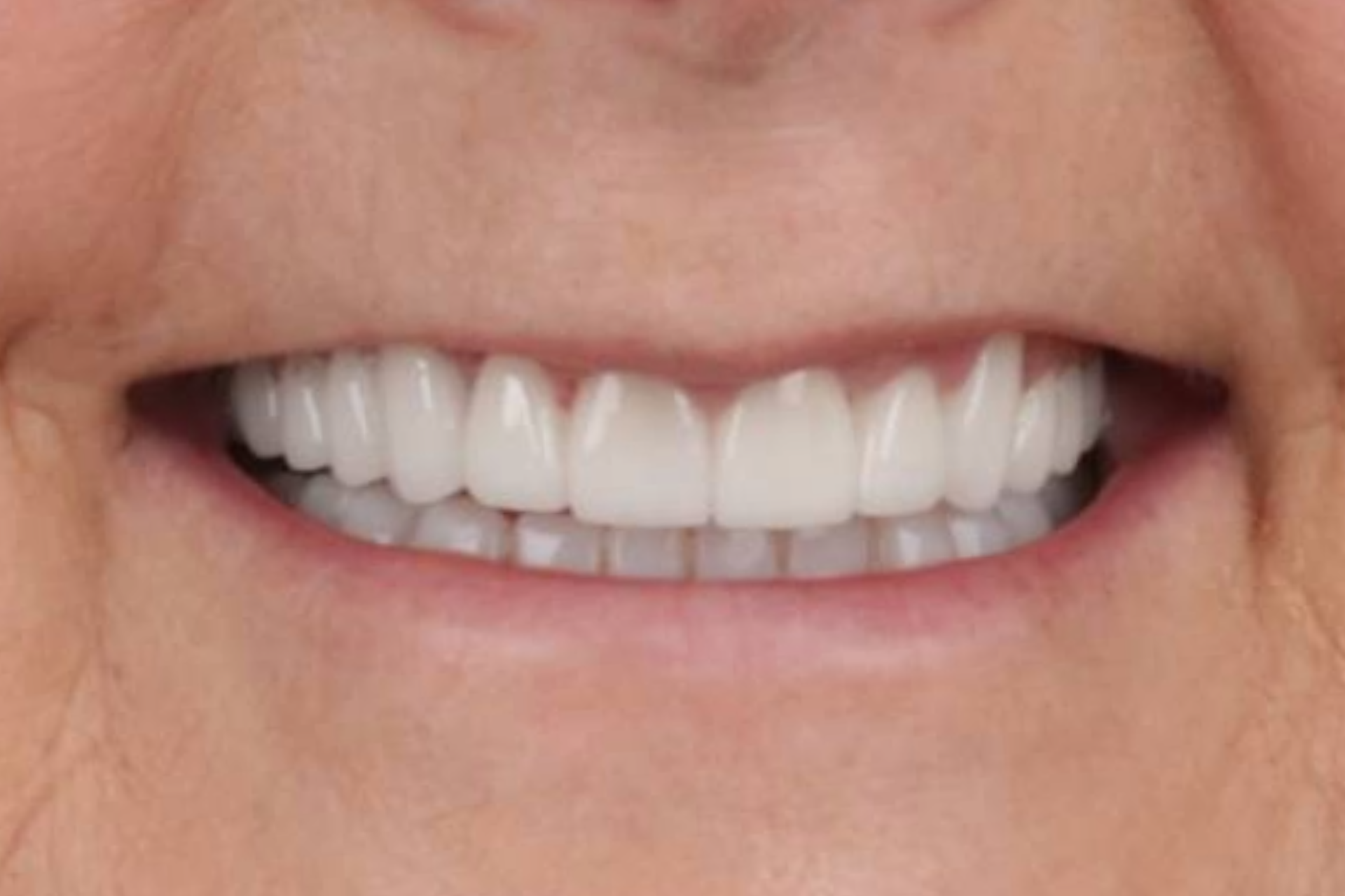 Metro Dental Invisalign Metro Dental Invisalign