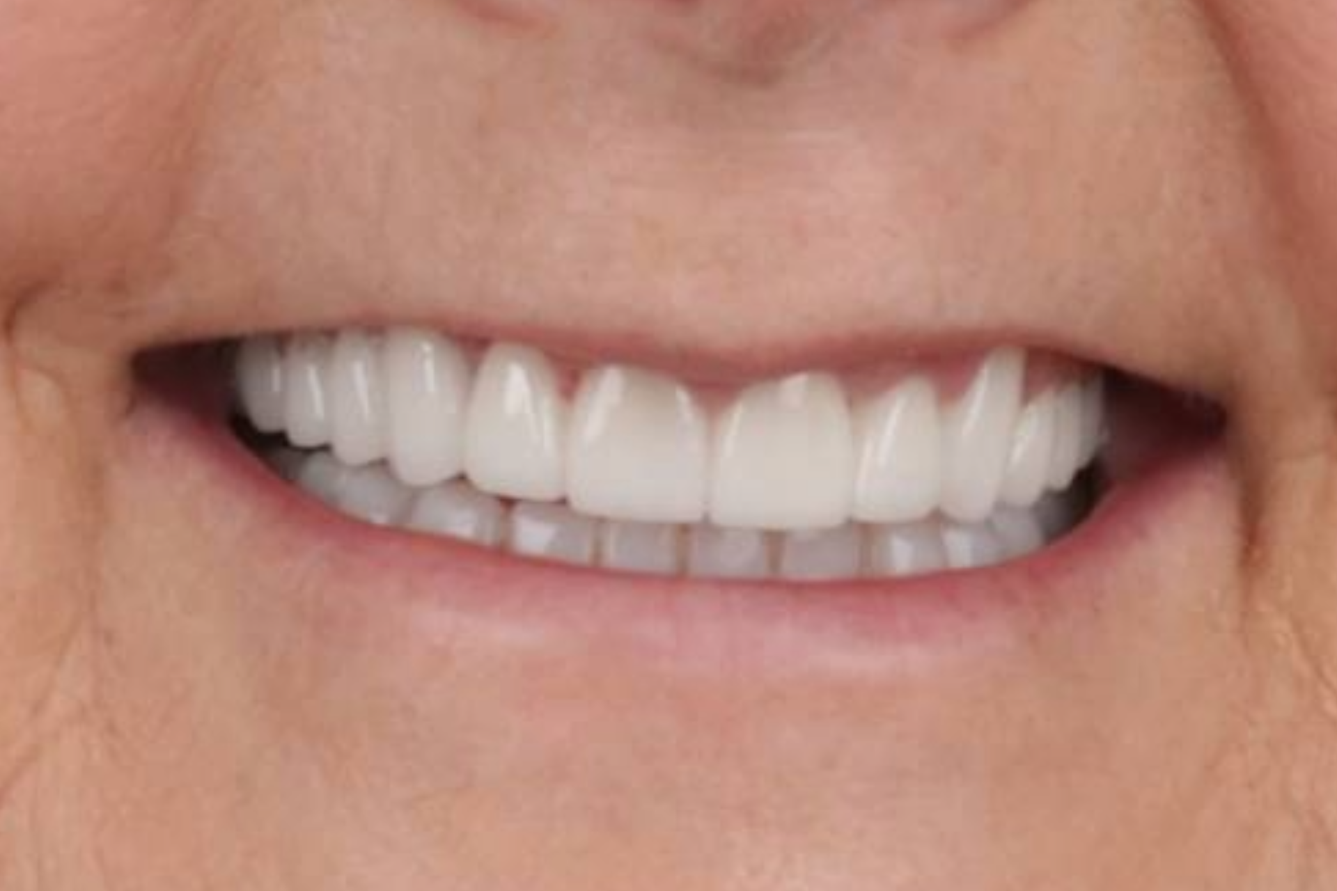 Melbourne Invisalign