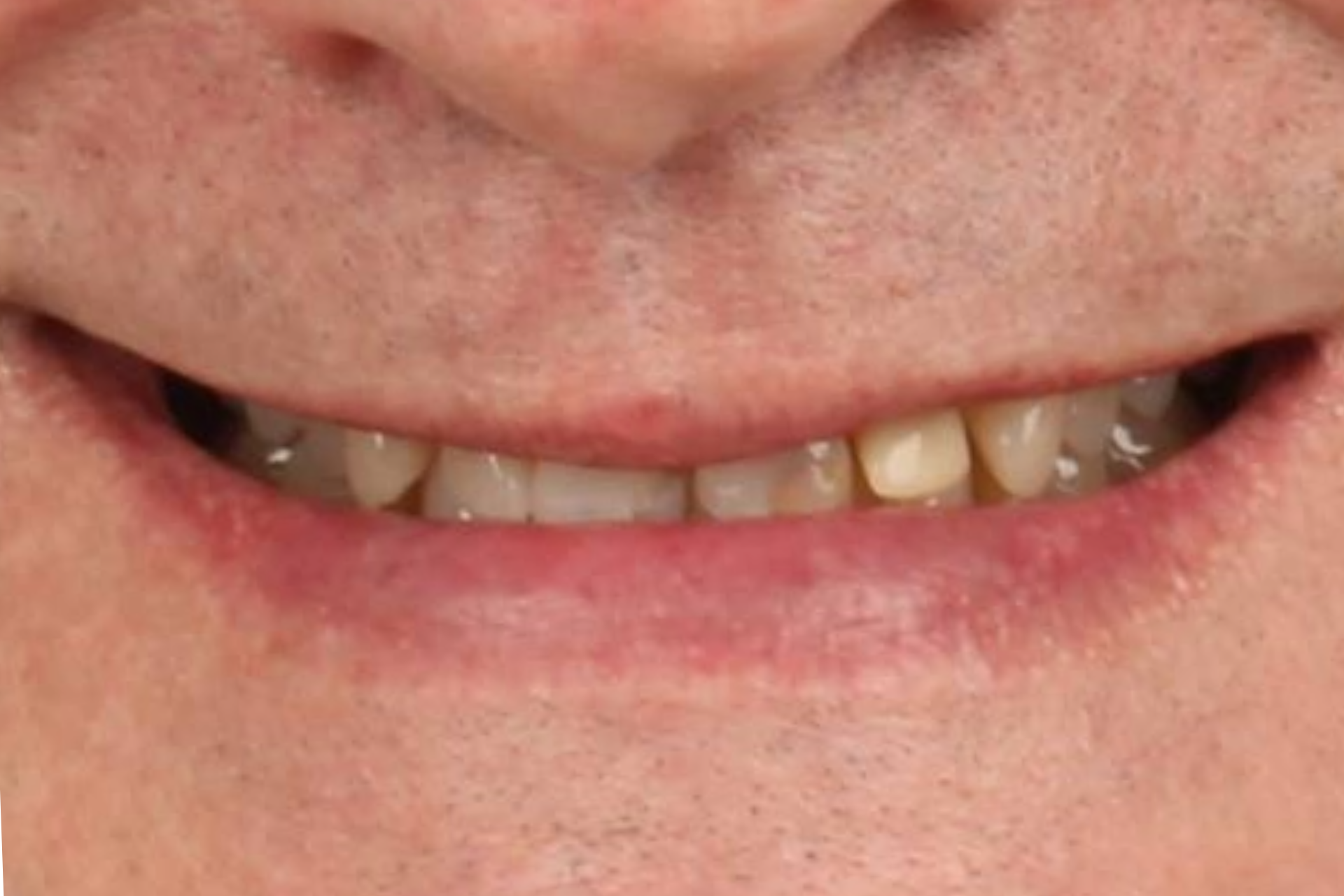 Metro Dental Invisalign Metro Dental Invisalign