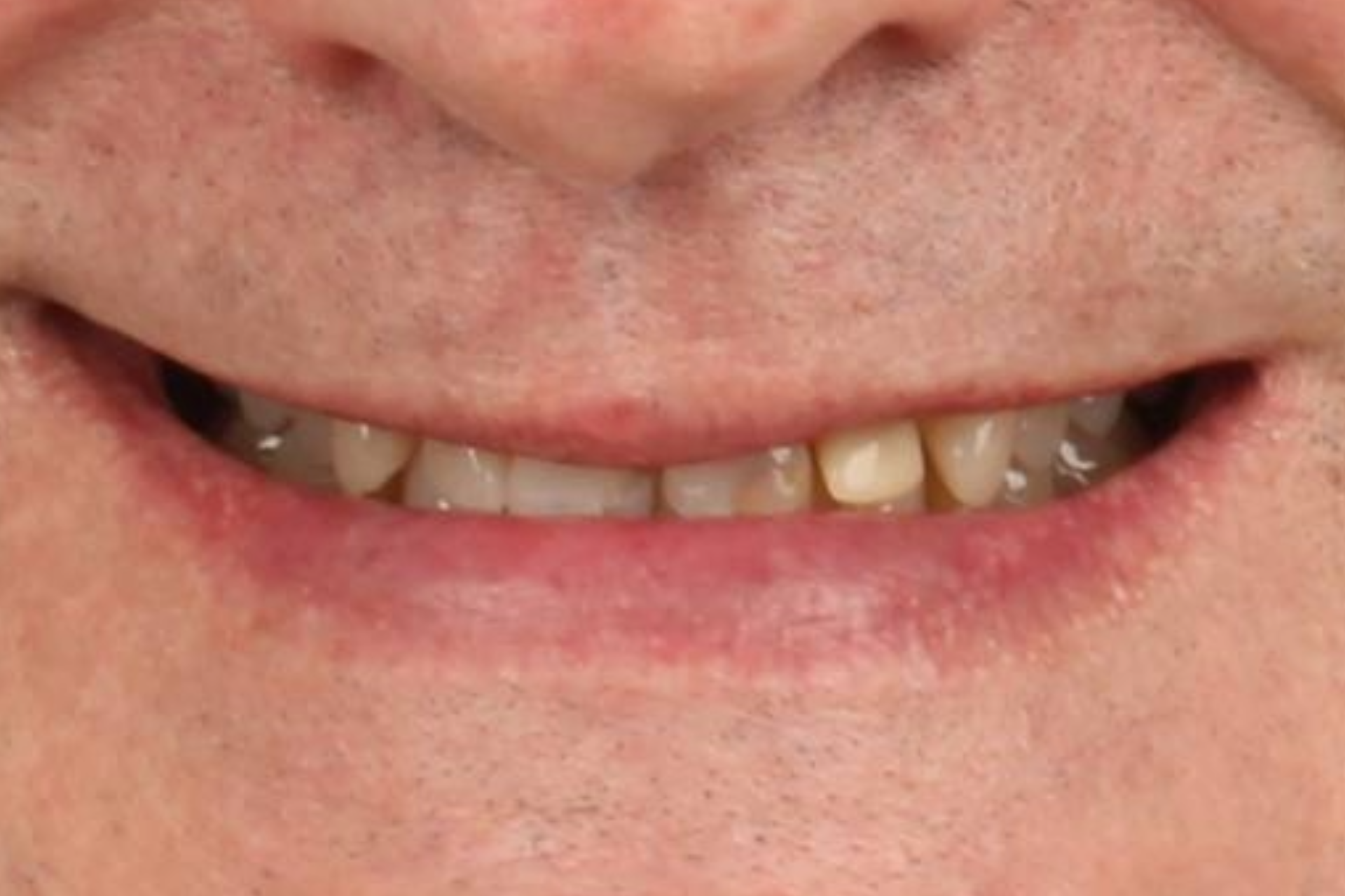 Melbourne Invisalign