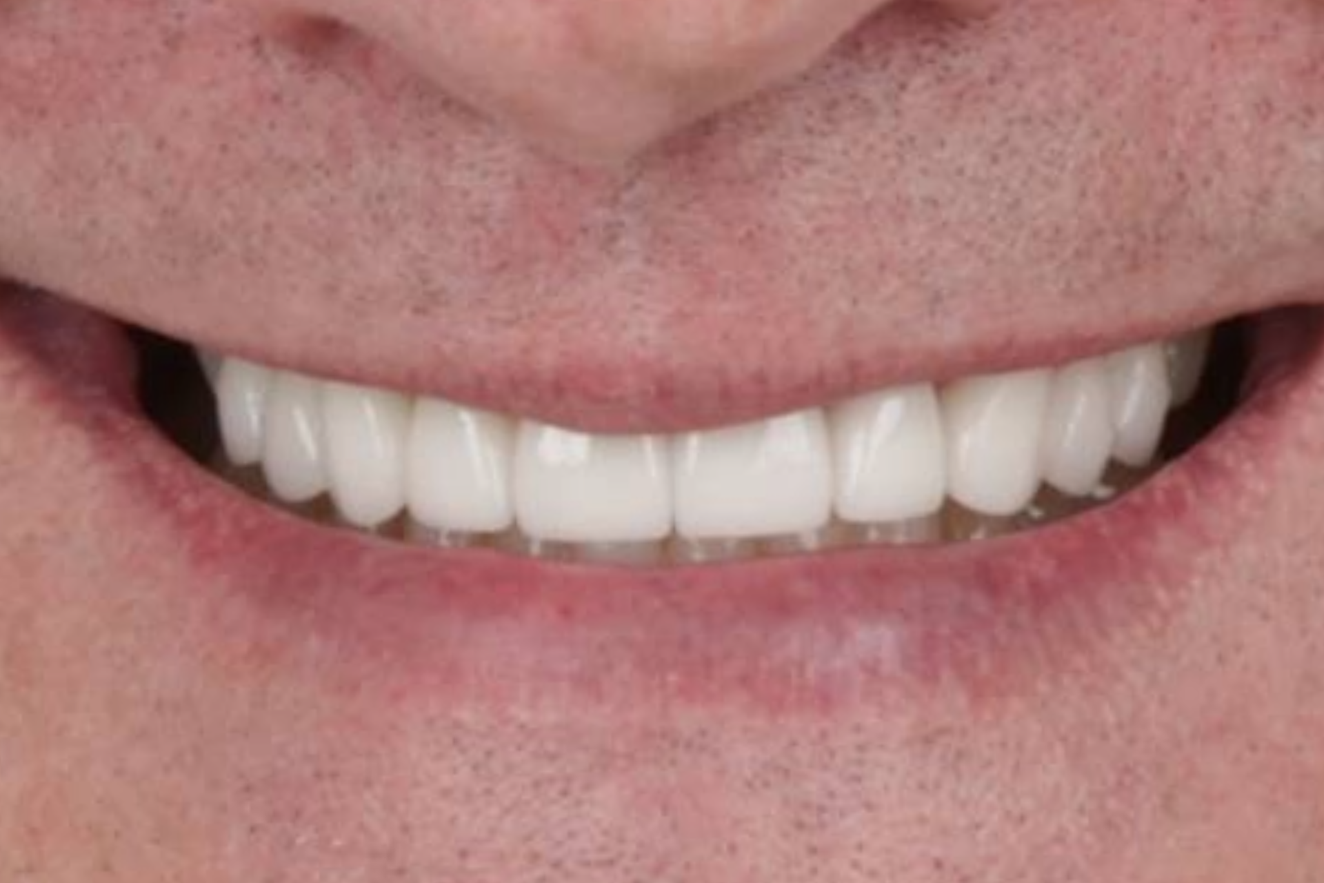 Metro Dental Invisalign Metro Dental Invisalign