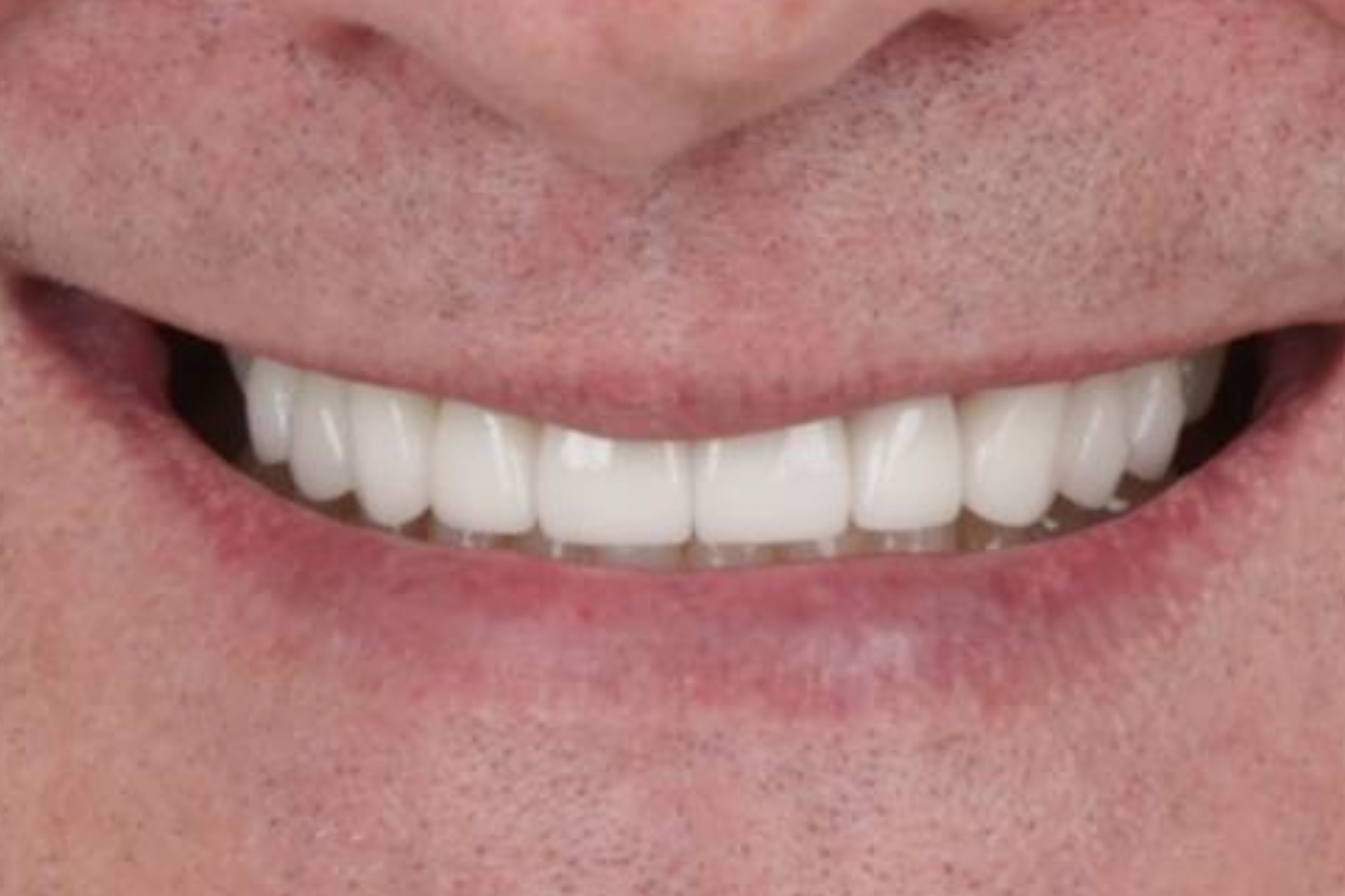Melbourne Invisalign