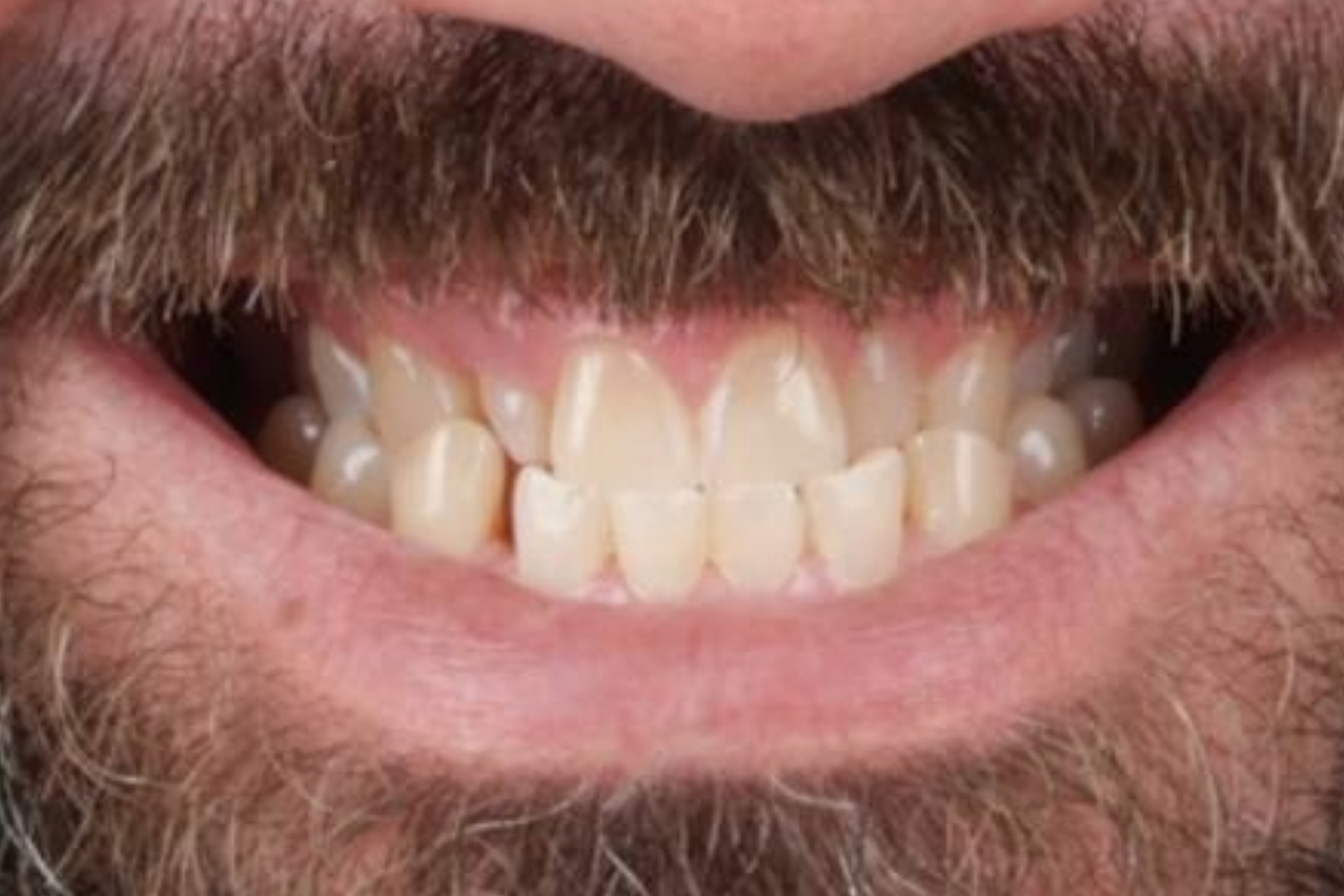 Melbourne Invisalign