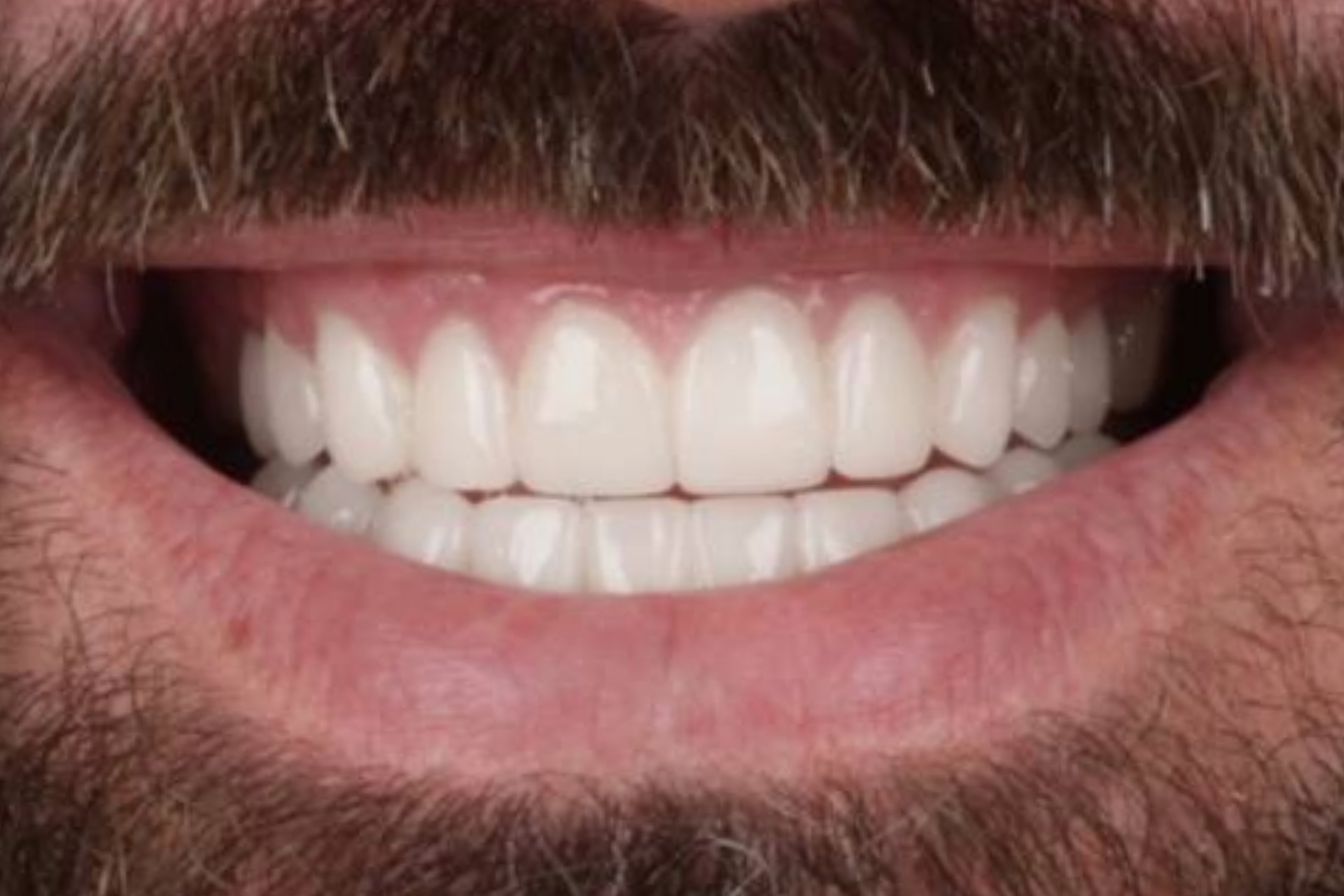 Metro Dental Invisalign Metro Dental Invisalign