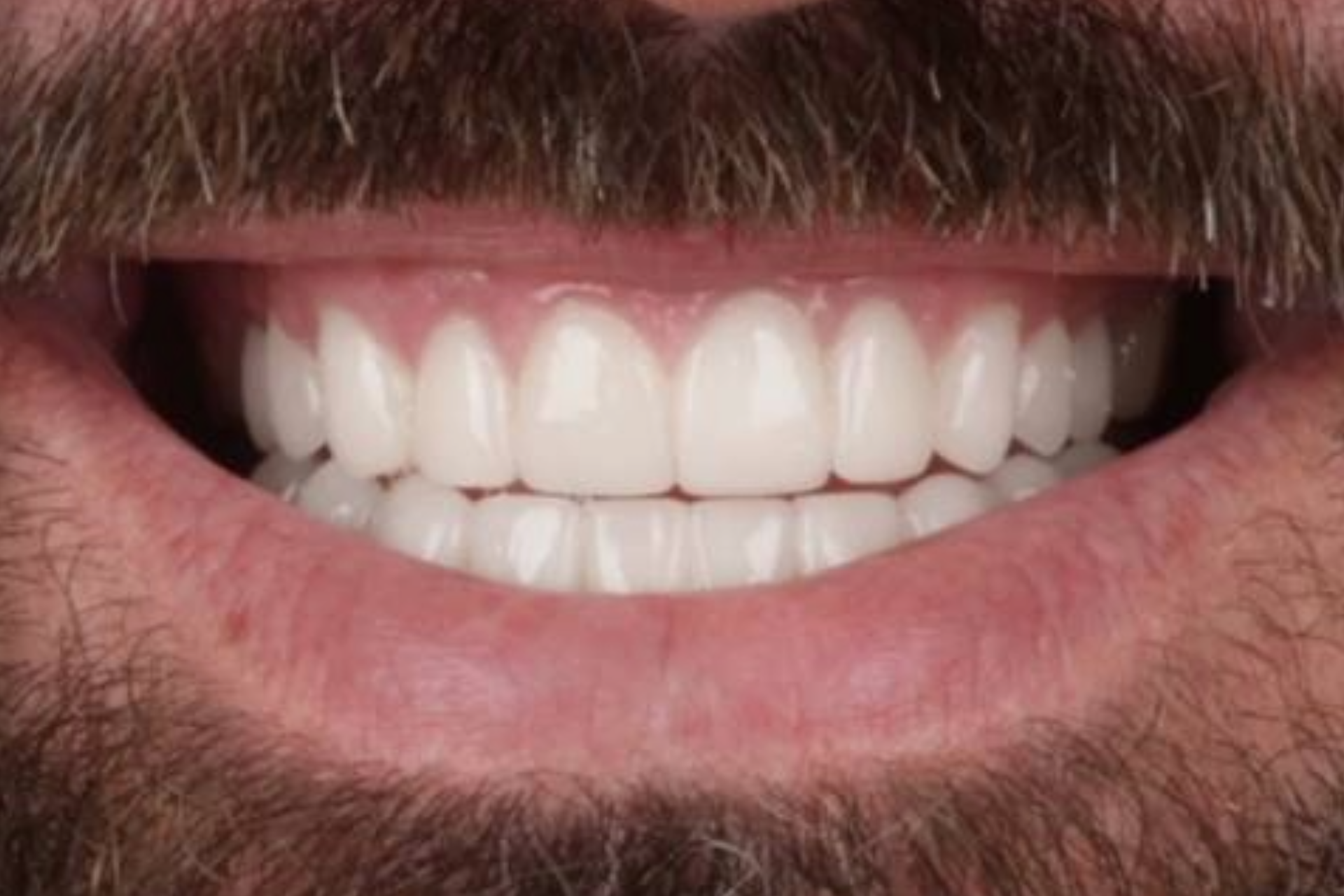 Melbourne Invisalign