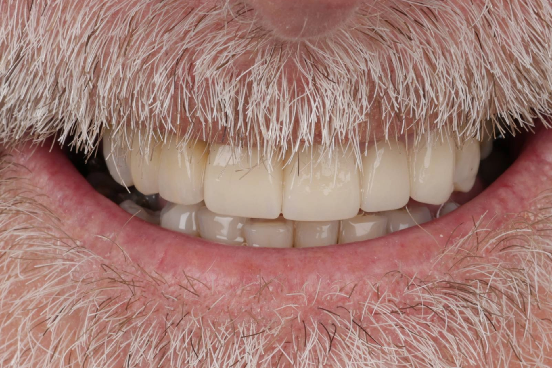 Melbourne Invisalign