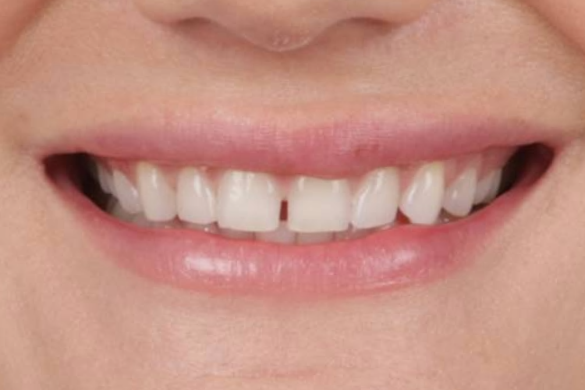 Metro Dental Invisalign Metro Dental Invisalign