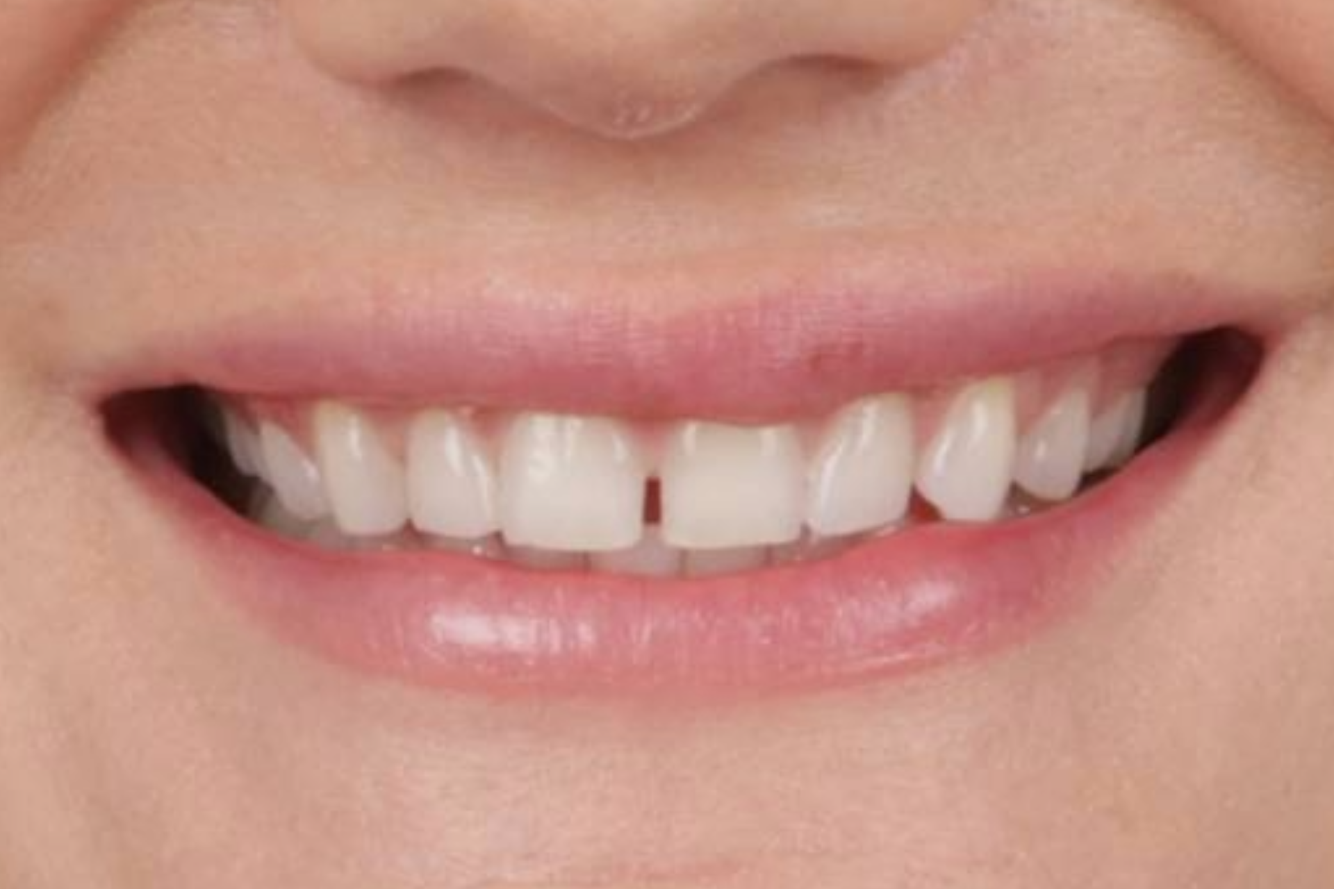 Melbourne Invisalign