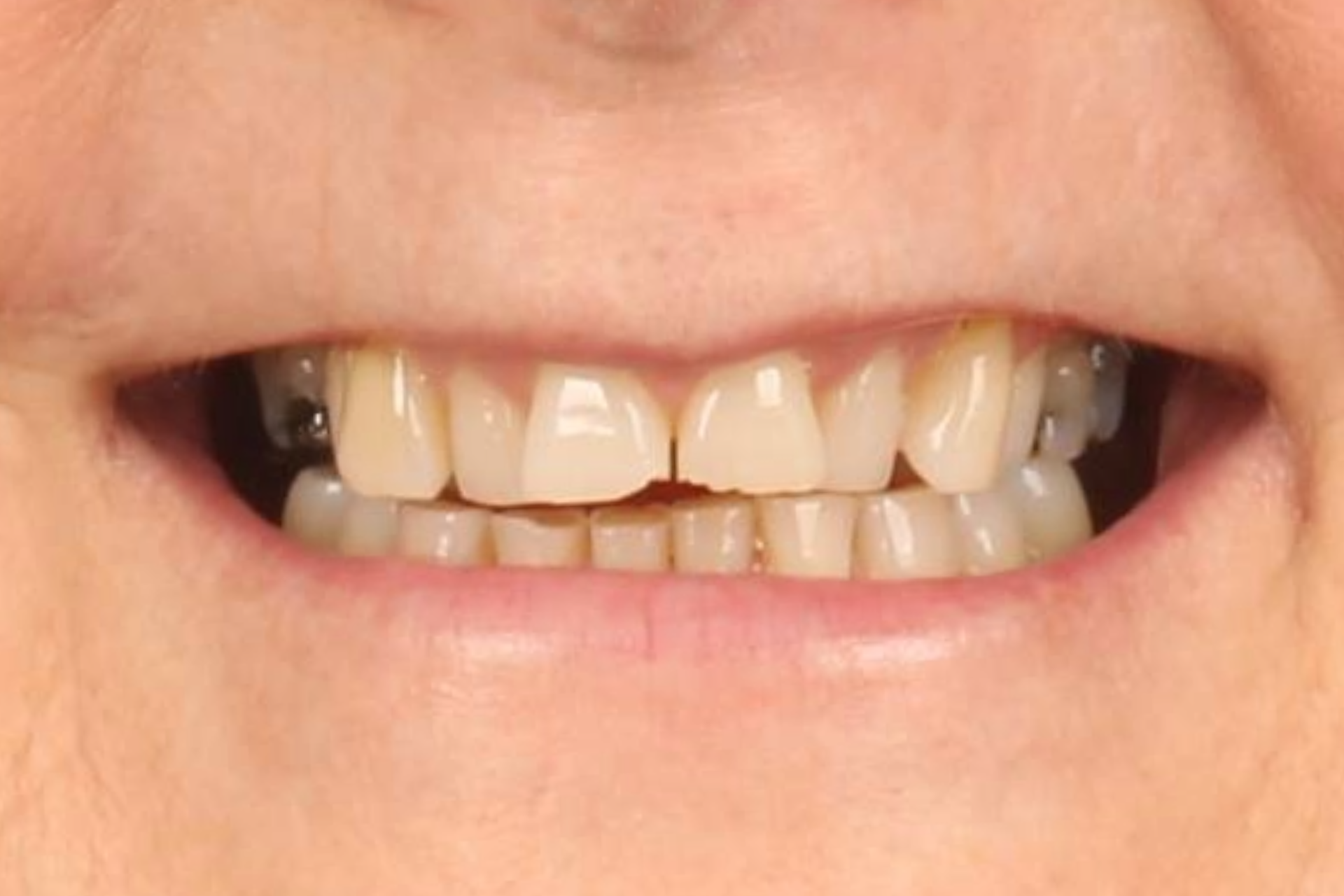 Metro Dental Invisalign Metro Dental Invisalign