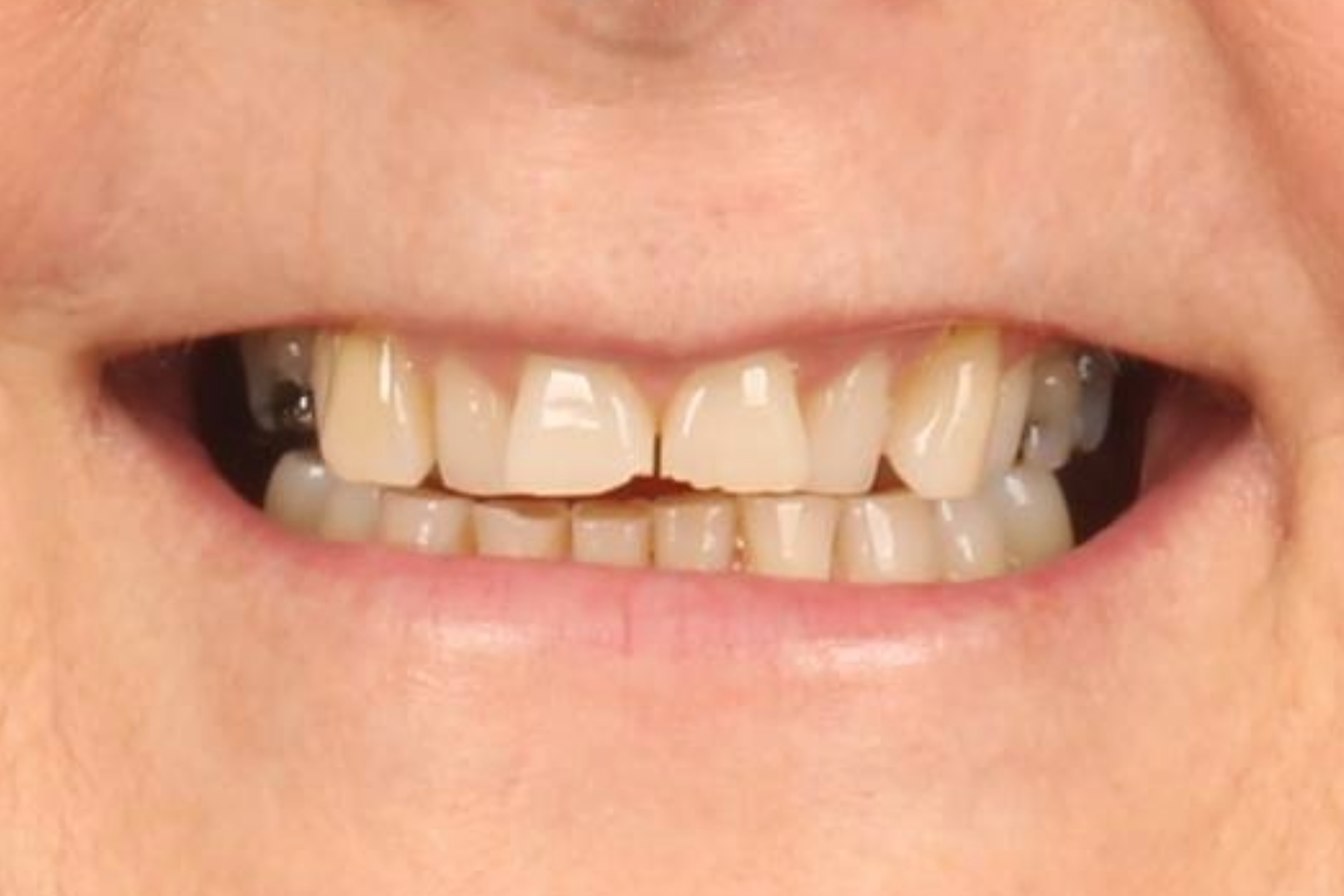 Melbourne Invisalign