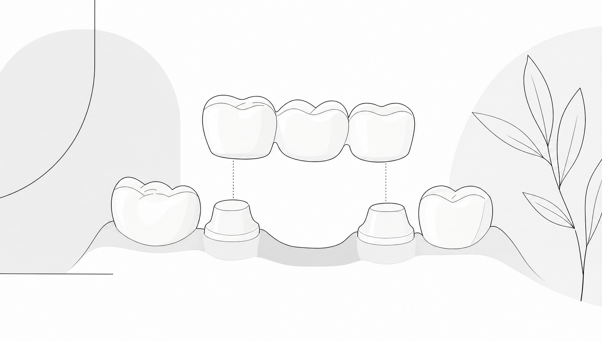 An adult patient and dentist discussing a simplified dental arch with a missing tooth and a three-unit bridge model in a calm clinical setting.