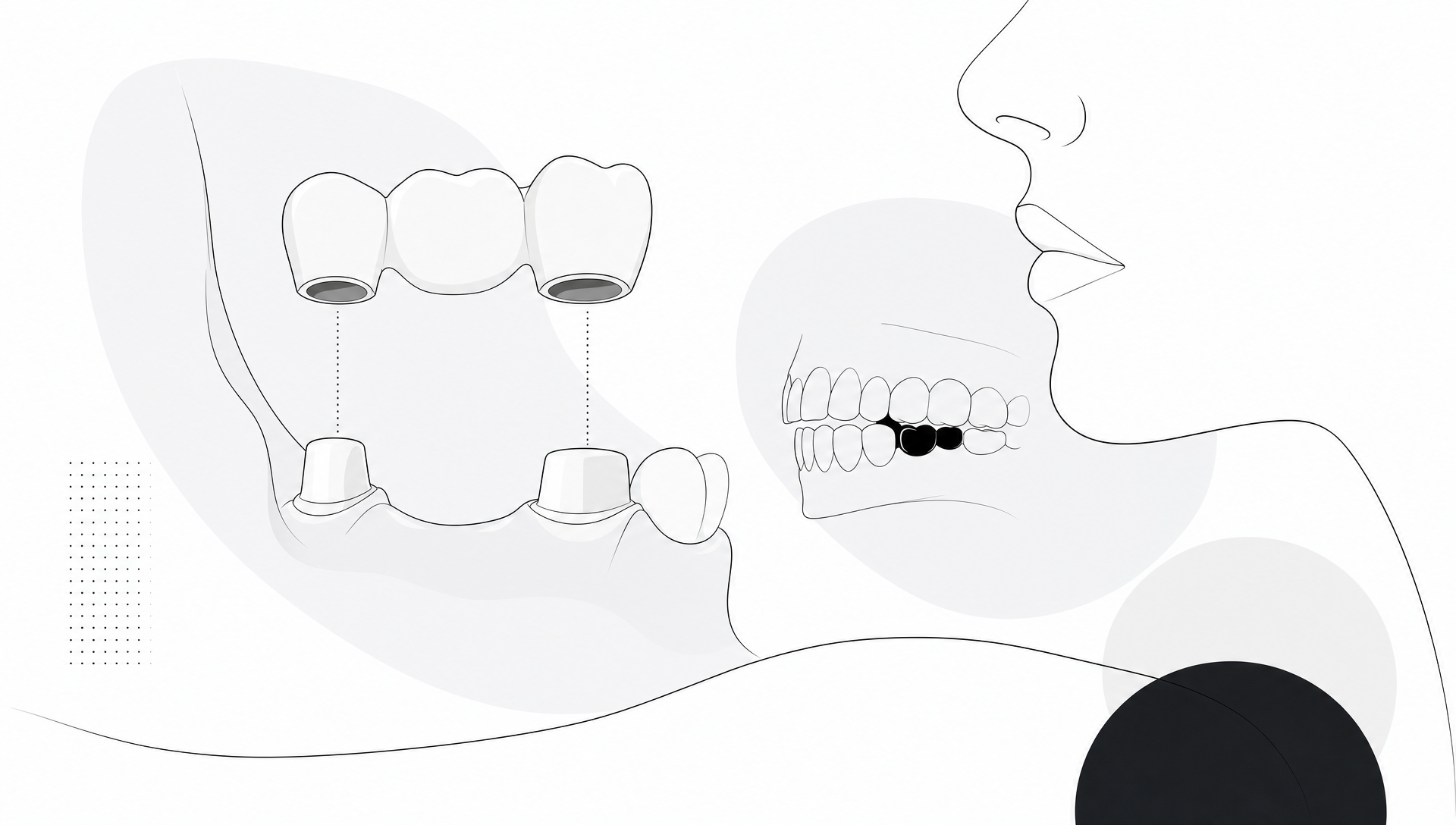 What to Ask a Dentist About Dental Bridges - Main Image